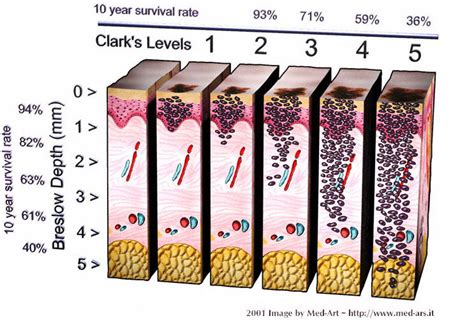 measuring melanoma thickness|clark level for melanoma staging.